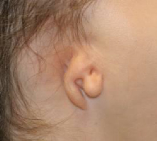 Microtia - Anotia - Casa di Cura Piacenza